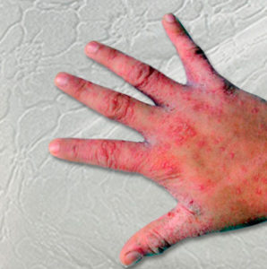 Scabies and human hand.